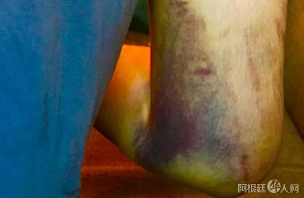 袭击造成海野雅威右臂和肩膀骨折，锁骨骨折，并伴随全身瘀青。(筹款网站GoFundMe)