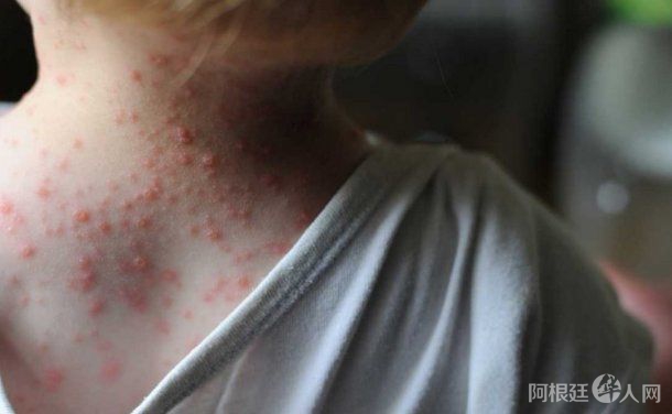 viruela-del-monojpg viruela-del-monojpg