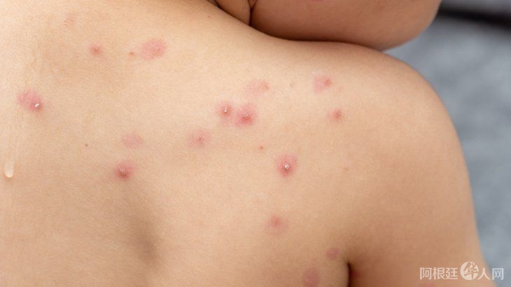 viruela-del-mono1jpg